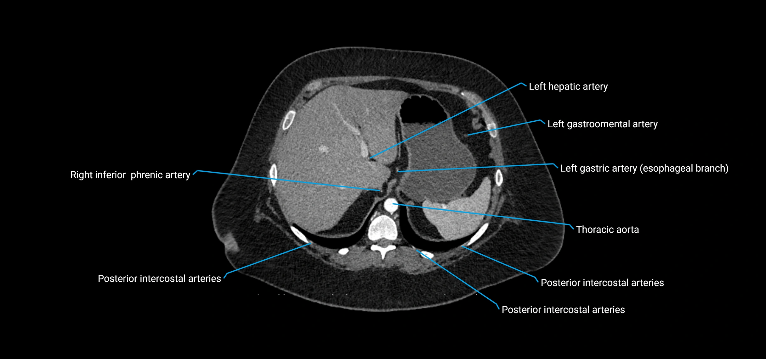 CTA abdomen axial cross sectional anatomy labelled image_35 (2).webp